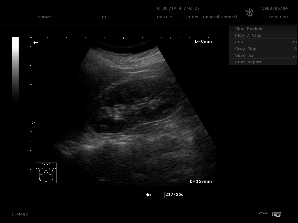 Index Of Transfer 00 Documentation 07 Edan Clinical Images Ultrasound Dus60 Others